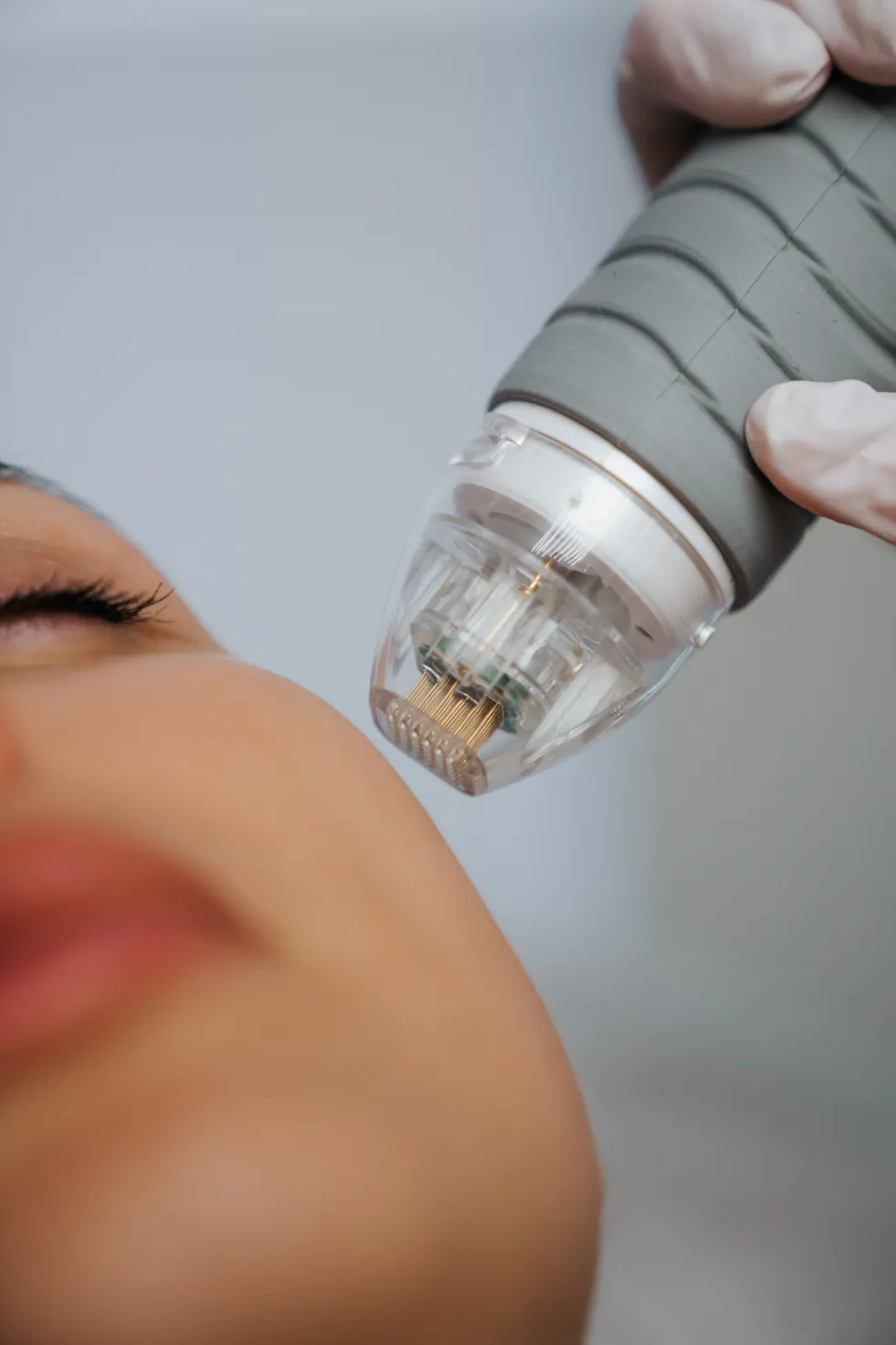 Microneedling — trattamento viso